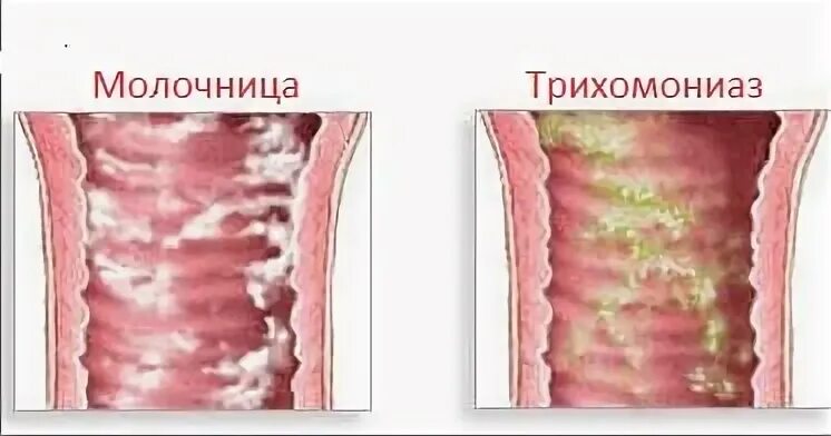 Схема приема флюкостата при молочнице у женщин. Молочница у женщины чем ее лечить. Схема лечения кандидоза у женщин. Схема лечения кандидоза. Молочница у женщины чем ее лечить.