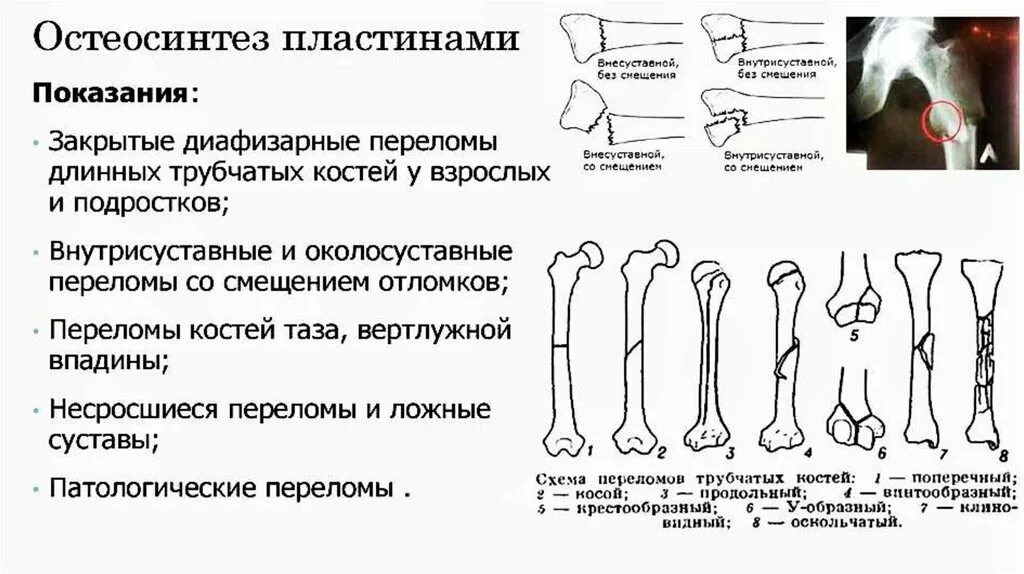 Перелом кости может быть каким. Перелом диафиза трубчатых костей. Механизмы переломов трубчатых костей. Основной симптом при переломе трубчатой кости. Классификация переломов трубчатых костей рентген.