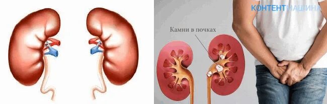 Камни в почках как проходит операция. Камни из почек операция. камни в почках после операции. операция по удалению почки.