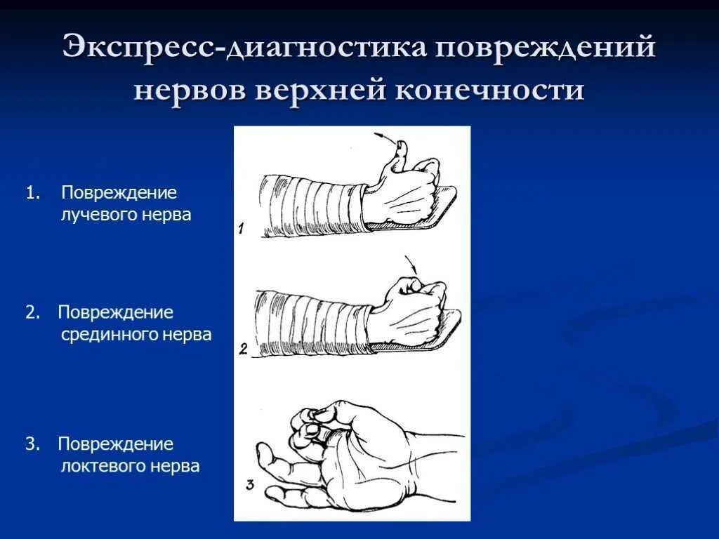 Повреждение локтевого нерва. Положение кисти при повреждении лучевого локтевого срединного нерва. Диагностические тесты повреждения лучевого нерва. Диагностика повреждений периферических нервов конечностей. Повреждение периферических нервов верхней конечности.