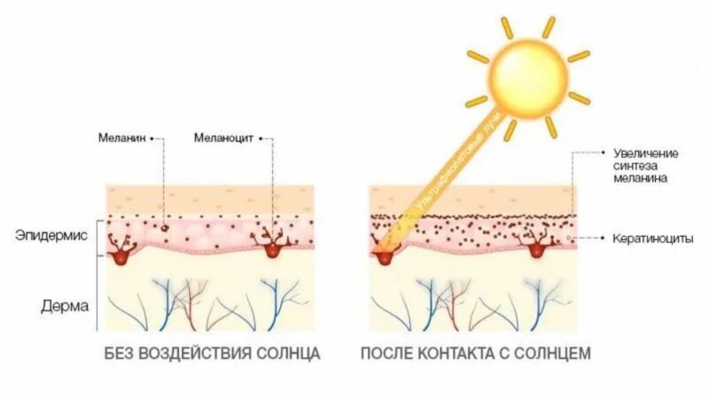 Под влиянием ультрафиолетовых лучей в коже. Синтез меланина в коже. гиперпигментация схема.