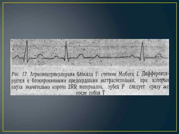 Блокады 2 степени армия. Блокированные предсердные экстрасистолы на ЭКГ. Атриовентрикулярная блокада 2 ст ЭКГ. Блокированная предсердная экстрасистолия и АВ блокада. АВ блокада 2 степени и желудочковая экстрасистолия.