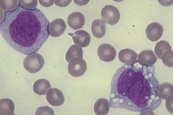Мононуклеары микроскопия крови. Клетки Боткина Гумпрехта это. Моноциты клетки. Клетки тени Боткина Гумпрехта. Реактивные лимфоциты у детей