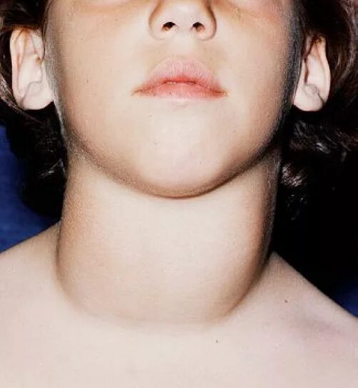 Гиперфункция щитовидной железы, базедова болезнь. Транзиторный гипотиреоз у детей. Щитовидка у детей симптомы. Детские заболевания щитовидной железы. Степени увеличения щитовидной железы.