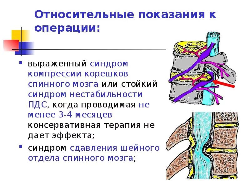 Синдром сдавления спинного мозга. Сдавление спинного мозга симптомы. Компрессия спинного мозга. Компрессия спинномозговых Корешков.