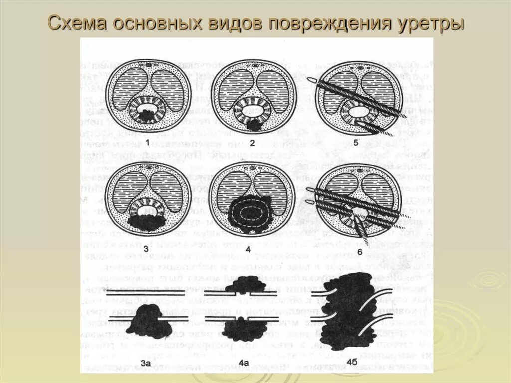 Повреждения уретры классификация. Классификация травм уретры. Разрыв уретры классификация. Травмы уретры (мочеиспускательного канала).