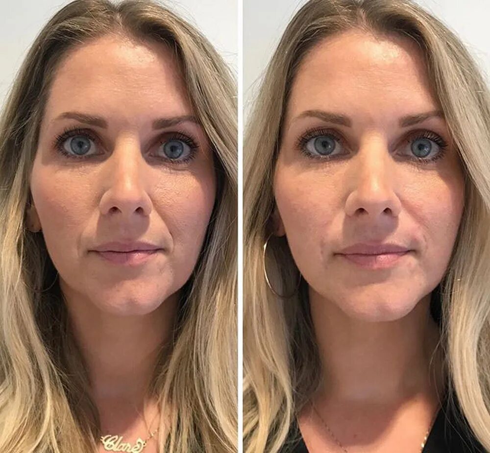 филлер через сколько эффект. филлер через сколько эффект. мезовайс си цитолайф. уколы в носогубные складки. до и после контурной пластики лица.