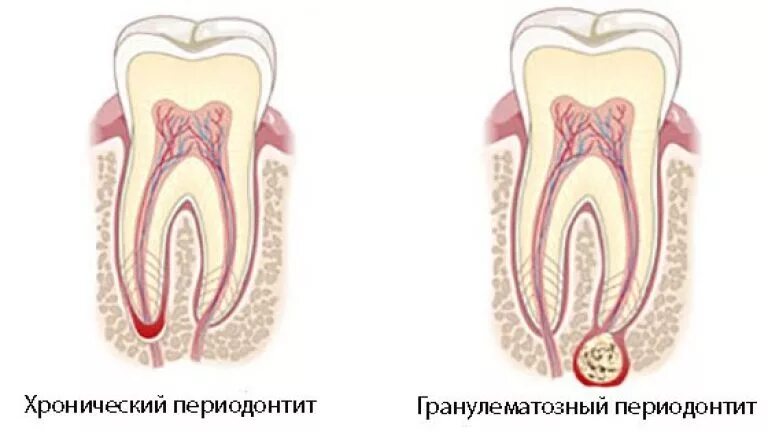 Фиброзный периодонтит. Периодонтит фиброзный гранулематозный гранулирующий. Хронический гранулематозный апикальный периодонтит. Хронический гранулематозный периодонтит клиника. Гранулематозный периодонтит зуба.