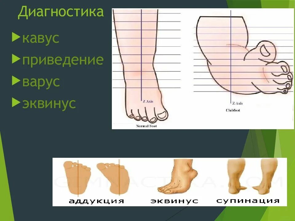 Болезнь шарко мари тута. Эквинусное положение стопы. Эквинус стопы. Эквинус стопы. Транскутанный шов ахиллова сухожилия.