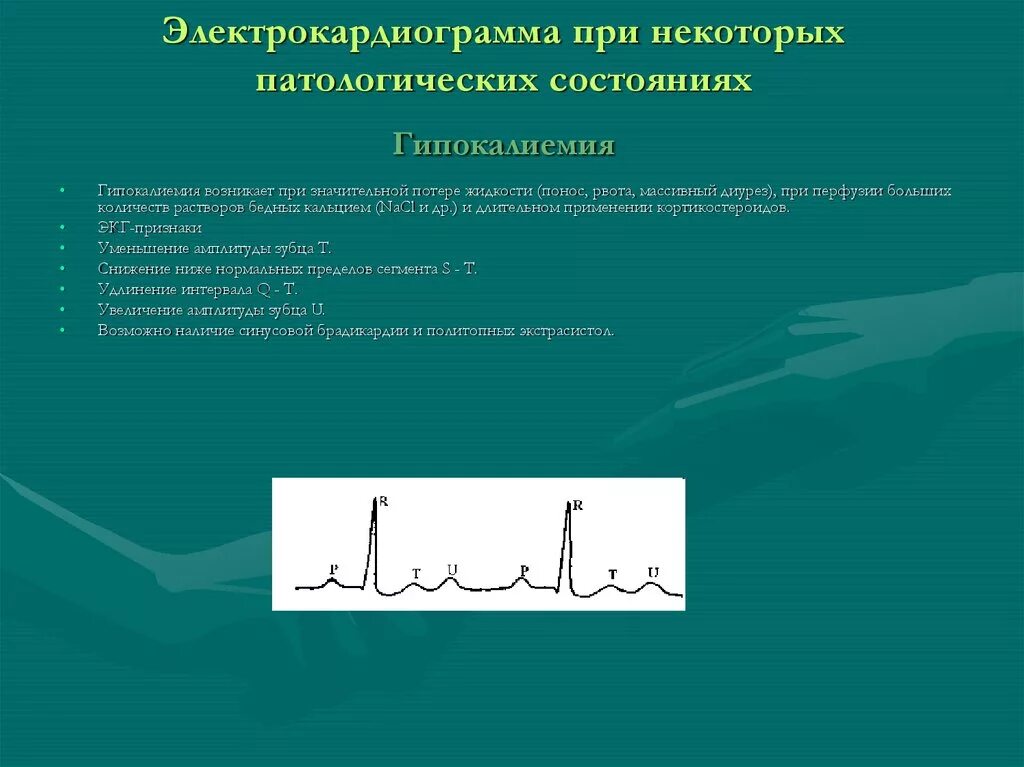 Гипокалиемия гипокальциемия. Гипокалиемия гипокальциемия. Гипокалиемия гипокальциемия. Гипокалиемия гипокальциемия. Гипокалиемия на экг признаки.