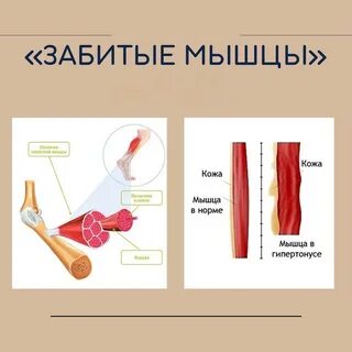 Забило мышцу на ноге что делать