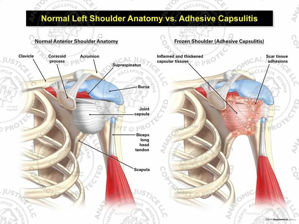 Ретрактильный капсулит плечевого сустава. Адгезивный капсулит плеча. Капсулит анкилозирующий. Плечевой капсулит симптомы.