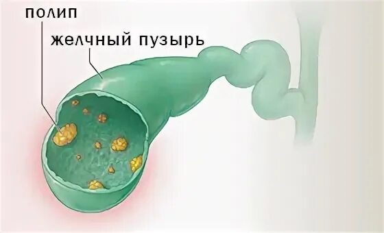 Полипоз желчного пузыря. Полип стенки желчного пузыря.