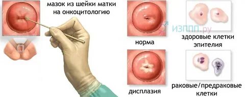 Цервикальный канал у женщин симптомы