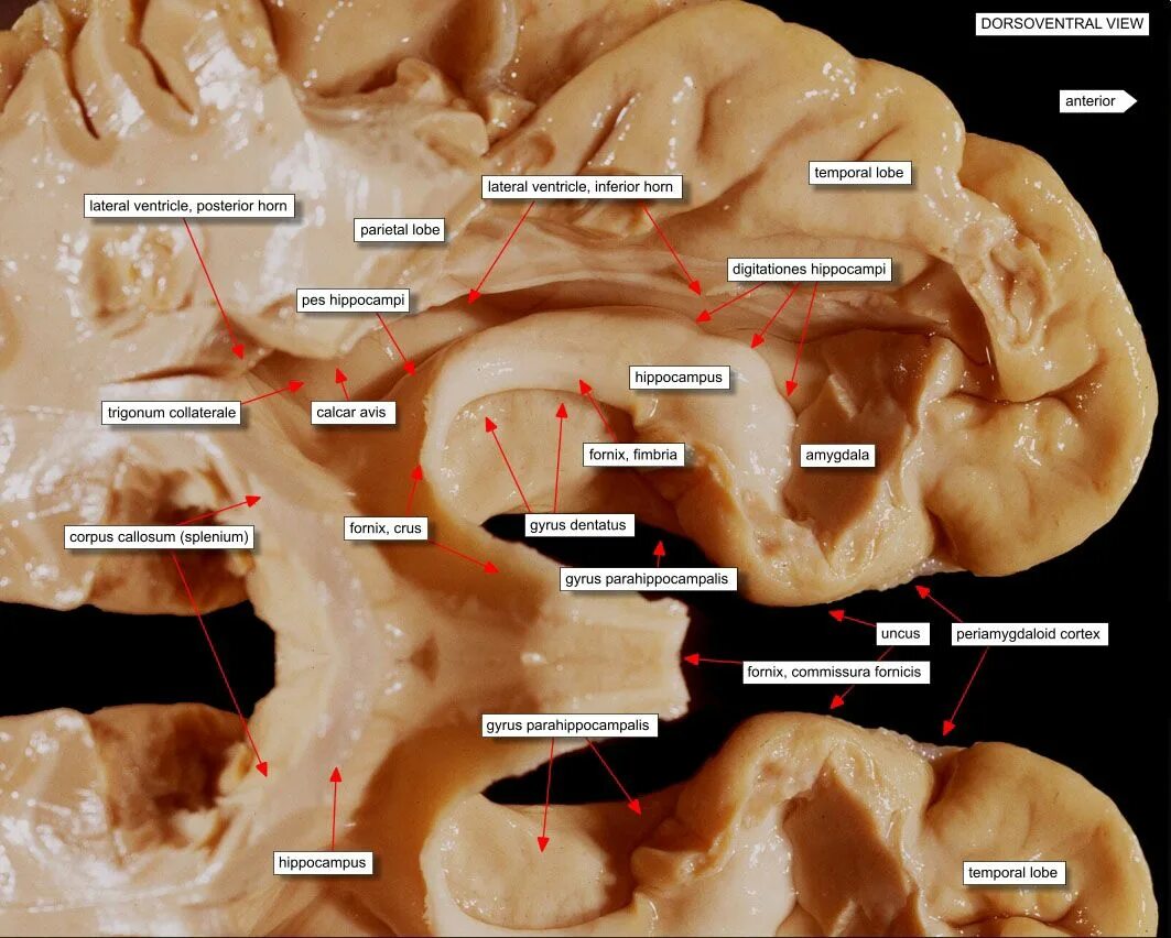 Повреждение гиппокампа. Гиппокамп анатомия. Hippocampus анатомия на препарате. Гиппокамп головного мозга.