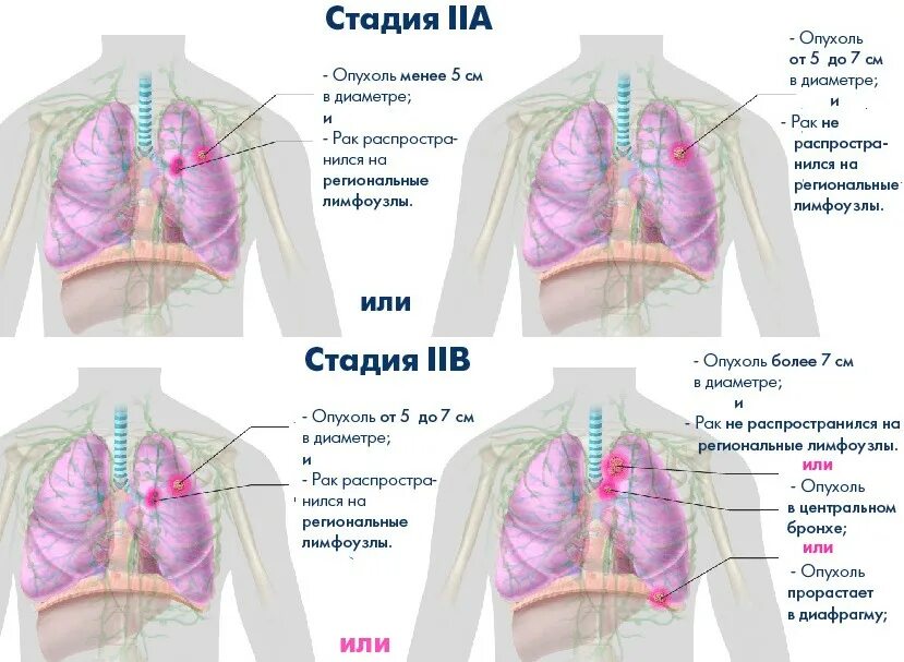 Легкие онкология 4 стадии. Онкология легких стадии. Стадии онкологии легкого. Бронхогенные метастазы в легких. Онкология 4 стадия отзывы