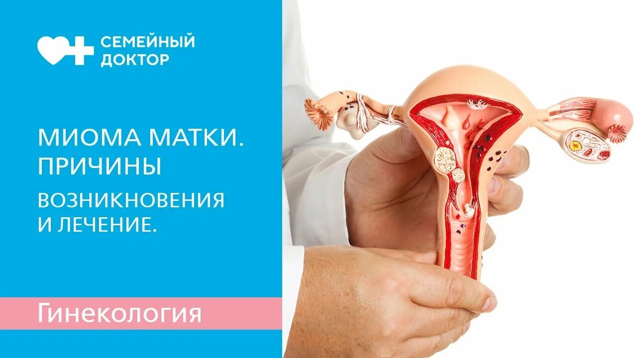 Причины появления миом. Миома причины возникновения.