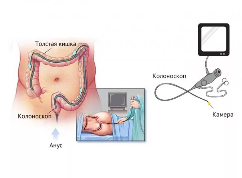 Где делают колоноскопию