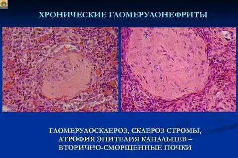 Умеренная атрофия