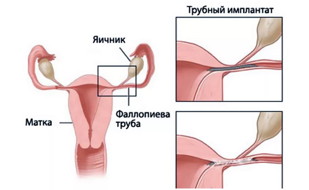 Перевязать трубы отзывы. Рассечение маточных труб. Стерилизация маточных труб. Перевязка маточных труб. Стерилизация маточных труб лапароскопия.