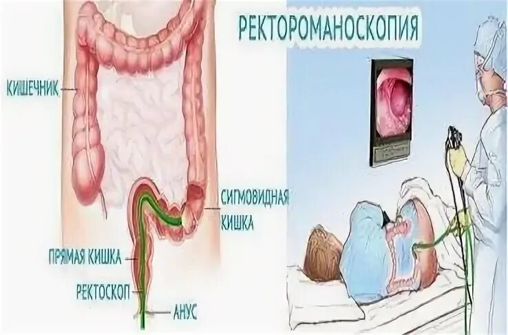 Что такое ректороманоскопия и как. Что такое ректороманоскопия и как