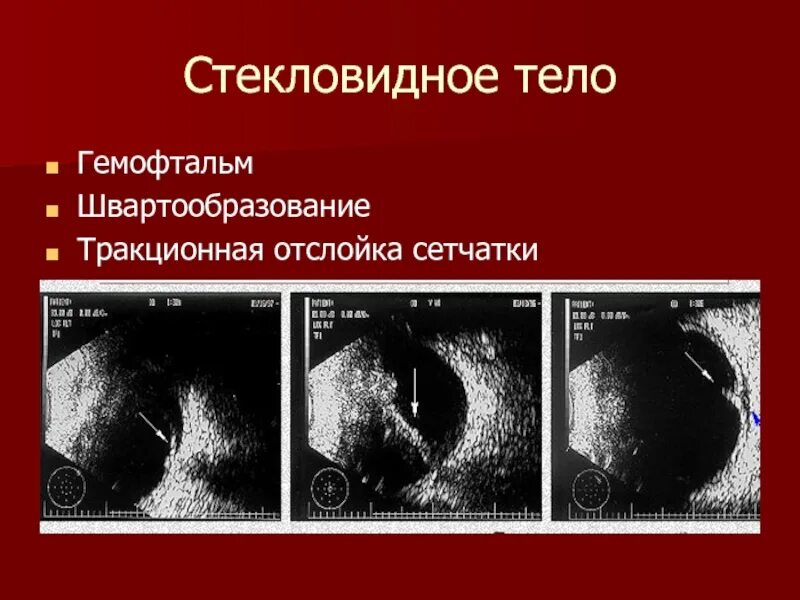 Гемофтальм мкб 10. УЗИ глаза отслойка сетчатки. Гемофтальм презентация.