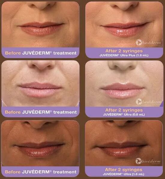 Губы после ювидерм. Juvederm Ultra smile, Juvederm Ultra 3. Juvederm Ultra smile плотность. Препарат Ювидерм 3 для губ 1 мл. Juvederm Ultra smile 0.5.