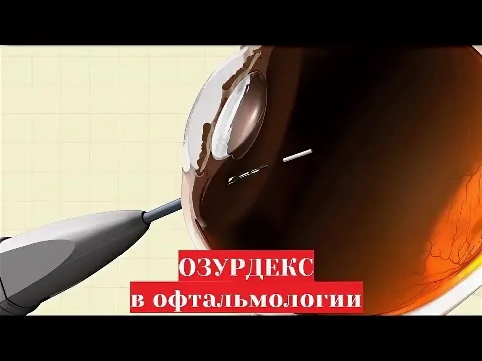 Озурдекс имплантат для интравитреального. Озурдекс в офтальмологии. интравитреальные инъекции в офтальмологии. интравитреальное введение препарата в глаз. имплант озурдекс.