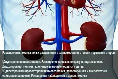 Расширена лоханка левой почки