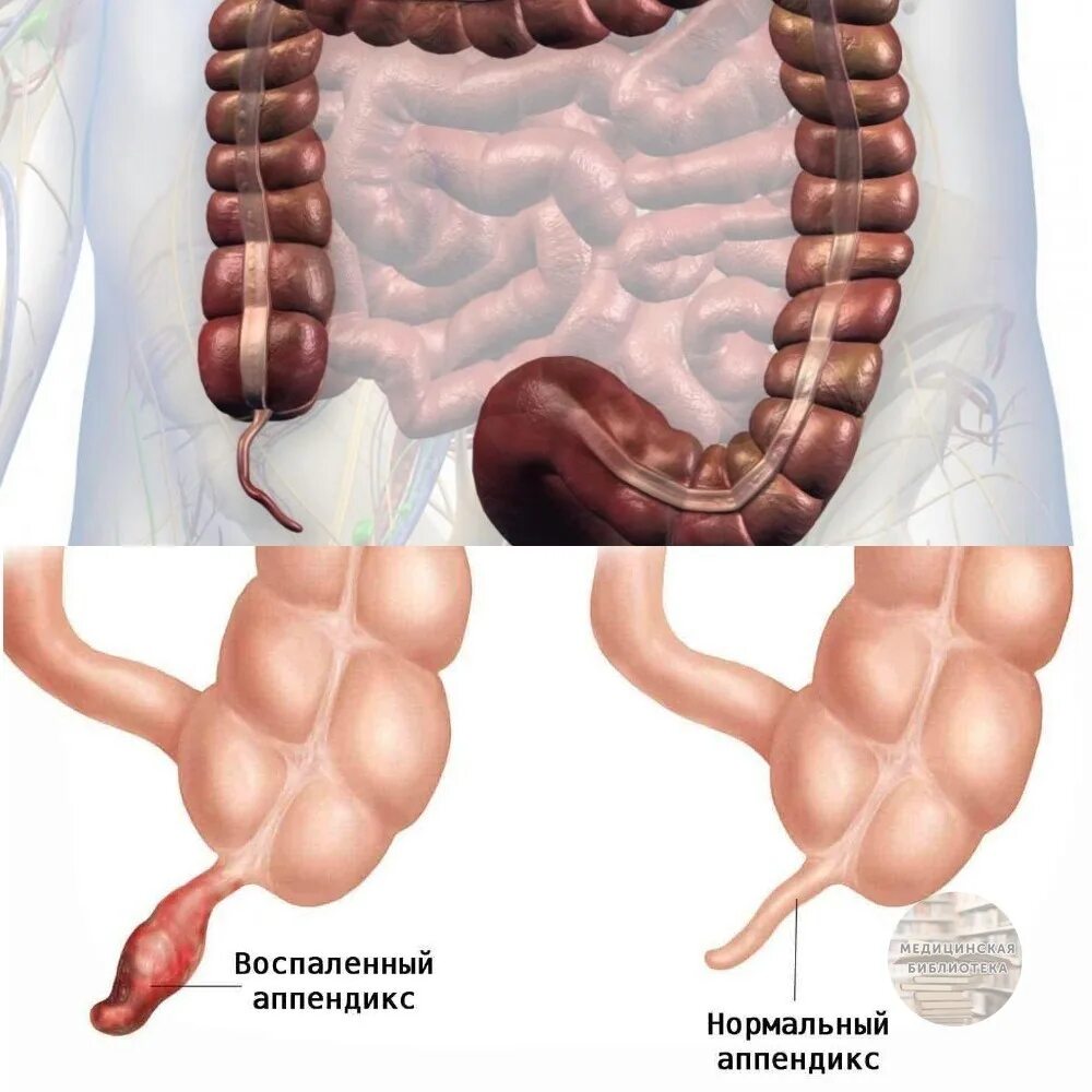 Воспаленный аппендикс. Червеобразный отросток слепой кишки. Толстая кишка аппендикс