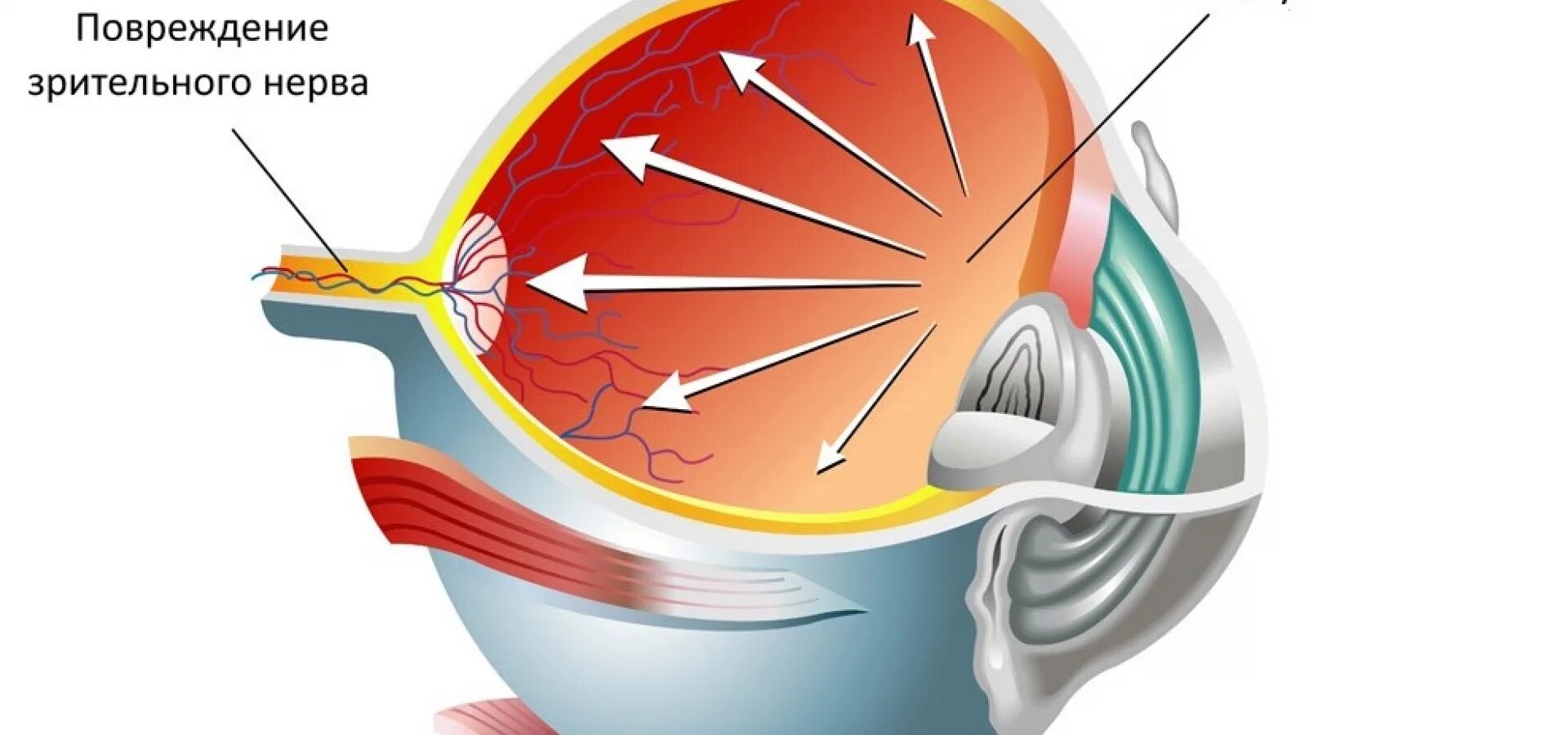 Разрыв зрительного нерва. Повреждение глазных нервов. Ранение зрительного нерва. Можно вернуть зрение при глаукоме