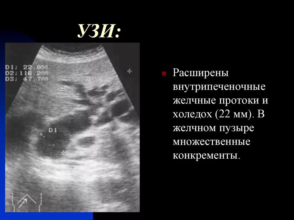 Желчный пузырь умеренный. Расширение внутрипеченочных желчных протоков на УЗИ. Желчный проток на УЗИ норма. Общий желчный проток на УЗИ. УЗИ пузырный желчный проток.