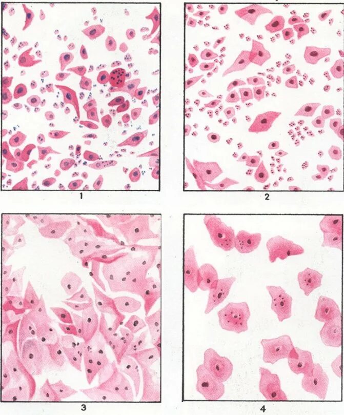 атрофированный вагинит. вагинит после 50. эстрогенный тип мазка на цитологию. постменопаузный атрофический вагинит. неинфекционный вагинит.