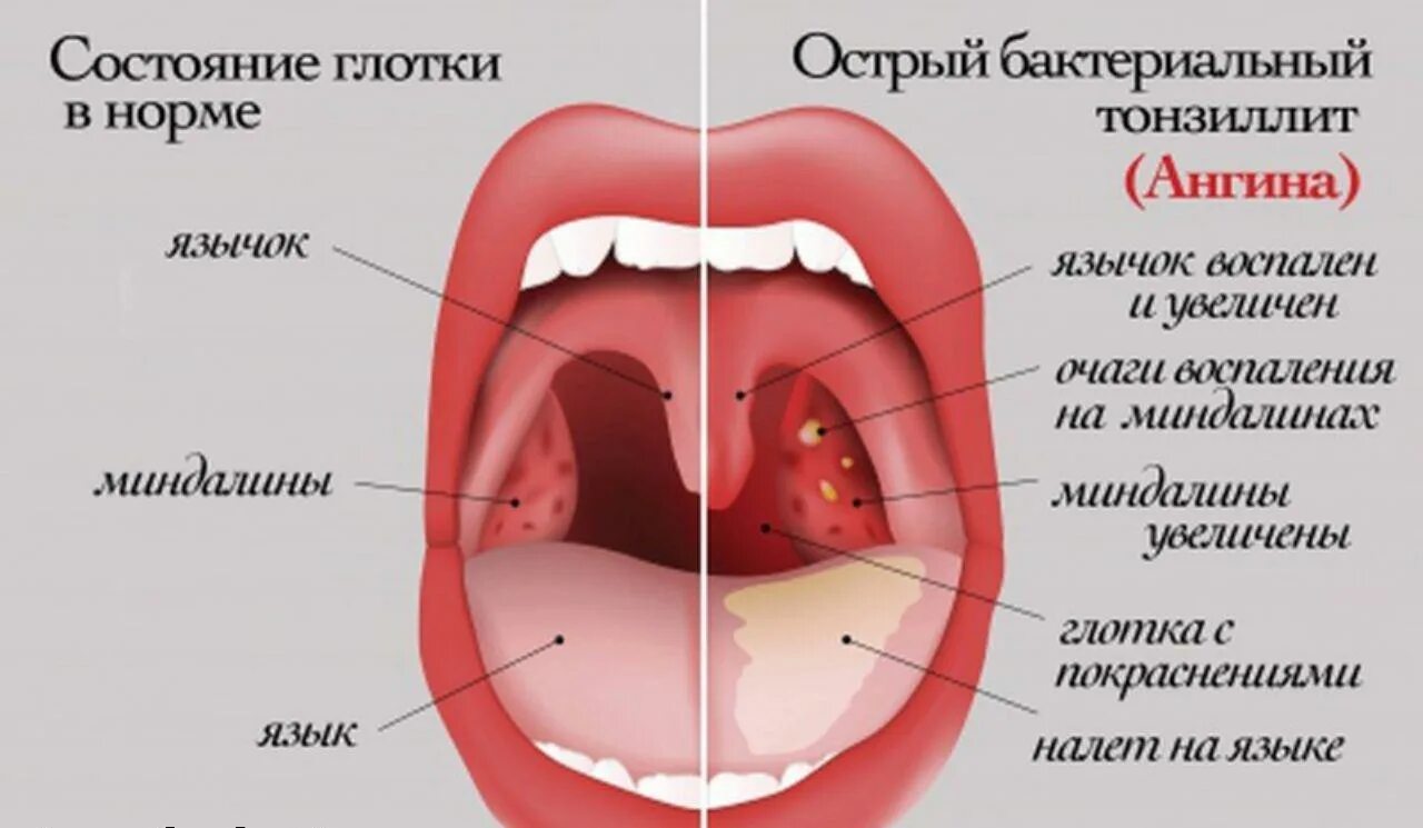 Ротовая полость норма. Ангина небных миндалин.