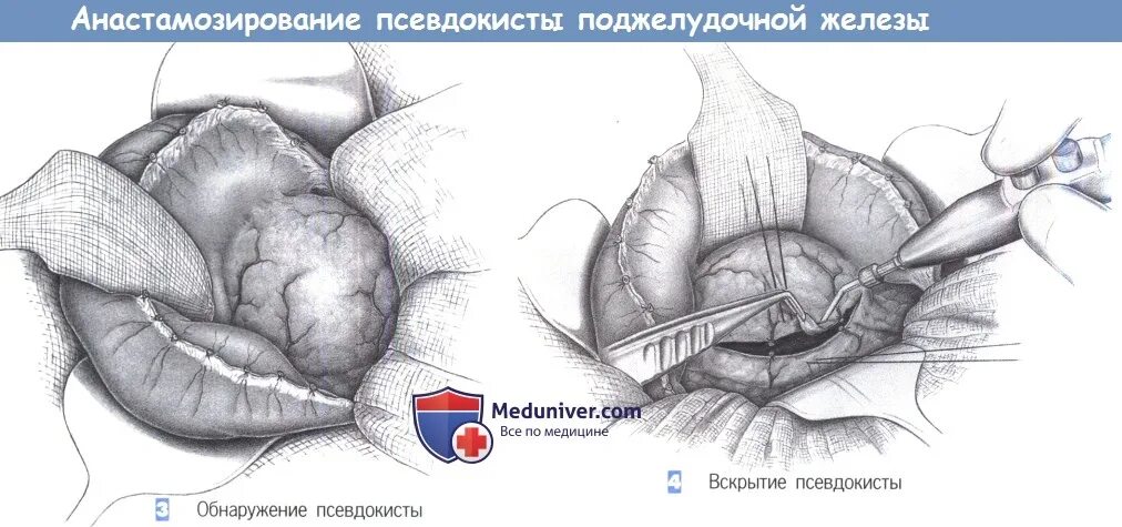 Псевдокисты поджелудочной железы. Операции при псевдокисте поджелудочной железы. Операции на поджелудочной железе этапы. Операции на поджелудочной железе доступы.