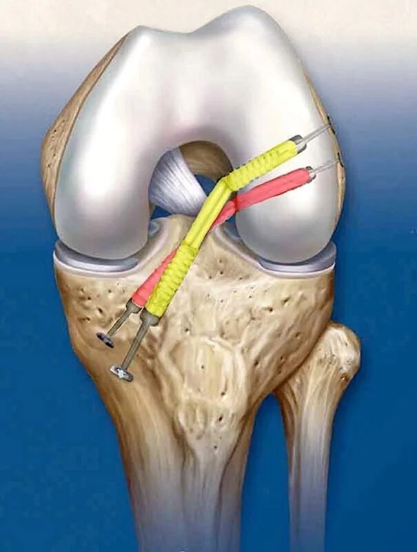 Связка мениска колена. ПКС (передняя крестообразная связка). Крестообразные связки коленного мениска. Артроскопическая резекция мениска. Операция пластика ПКС коленного сустава.