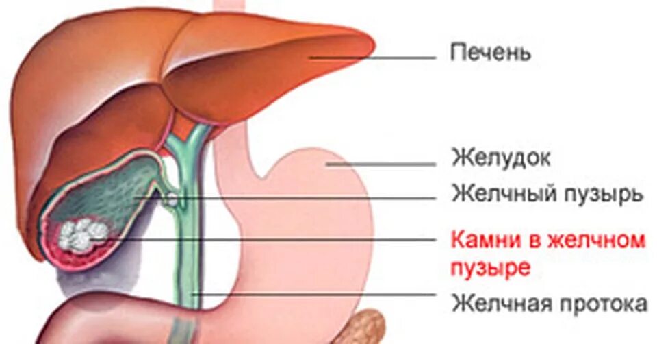 Желчнокаменная болезнь. Камни в желчных протоках.