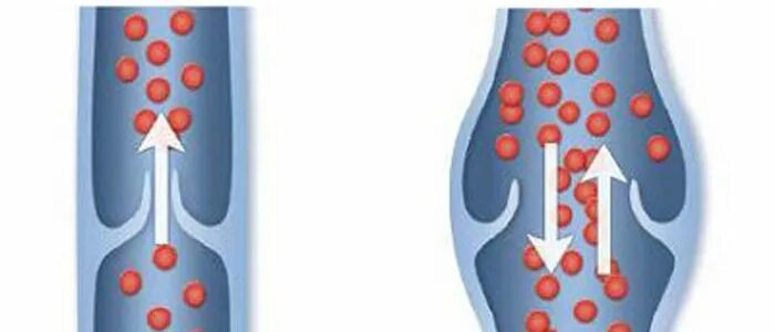 Вены ног клапаны. Клапанный аппарат вен нижних конечностей.