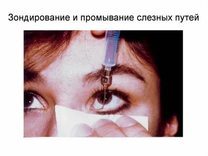 Промывание слезных путей