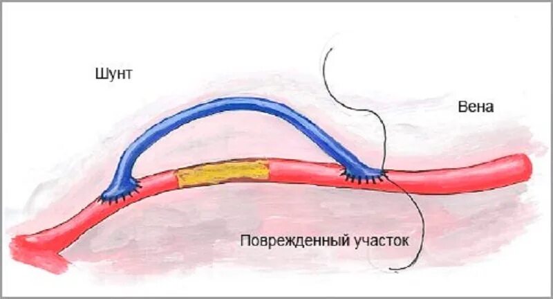 Шунт в медицине. Шунтирование коронарных артерий. Шунтирование, стентирование артерий. Шунтирование сосудов сердца стент. Шунтирование кровеносных сосудов.