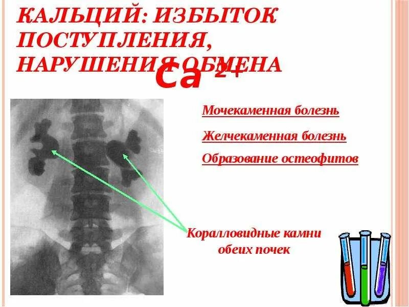 Нарушения кальция в организме. Избыток кальция в организме. избыток кальция в организме заболевания. избыток ca. избыток кальция в организме последствия.