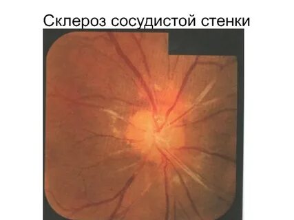 Склероз кожи