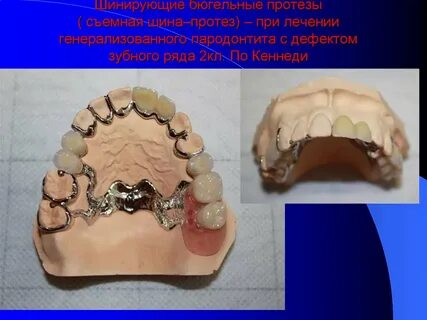 Элементы бюгельного протеза