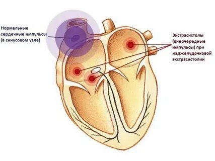 Нжэс в кардиологии