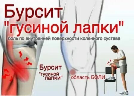 Бурсит гусиной лапки как лечить. Бурсит гусиной лапки как лечить