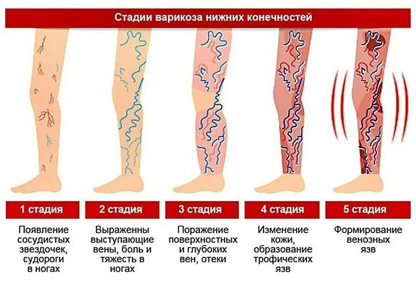 1 Стадия варикоза вен нижних конечностей. Варикозное расширение вен нижних конечностей стадии развития. Варикозное расширение вен 1 степени. Стадии клинического течения варикозного расширения вен.