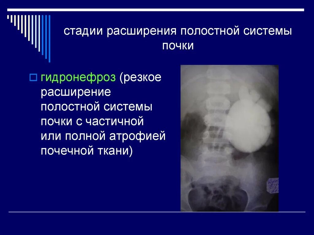 Полостная система почки расширена что это. Расширение полостной системы почек. Стадии расширения полостной системы почки. Врожденные пороки развития почек и мочевыводящих путей. Причины расширения почек