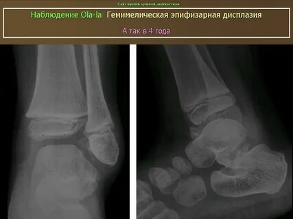 Эпифизарная дисплазия голеней рентген