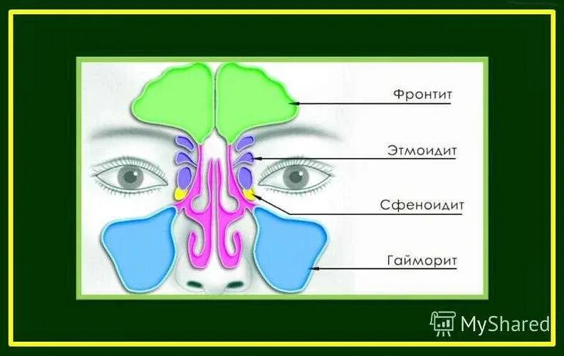 Сфеноидит симптомы