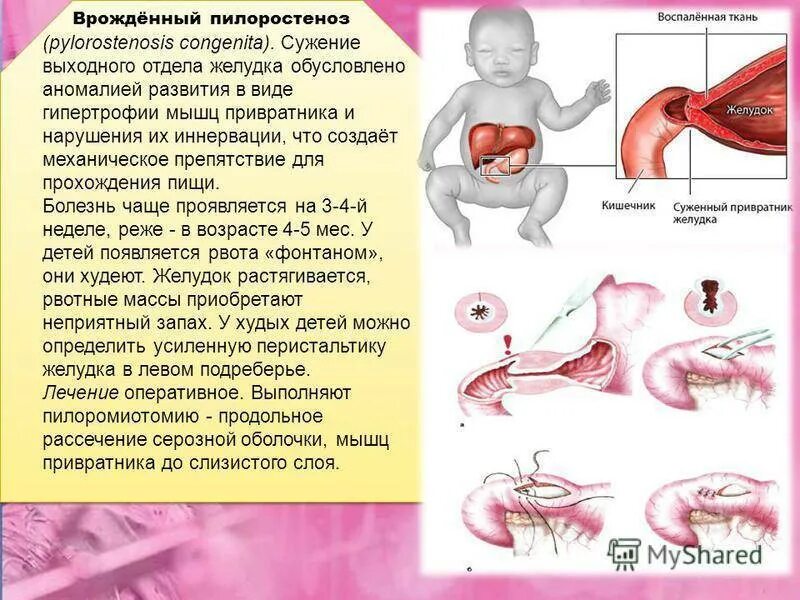 Стеноз кишечника что это. Врожденный пилоростеноз операция. Пилороспазм и пилоростеноз у детей. Врожденный гипертрофический пилоростеноз. Пилоростеноз у новорожденных.